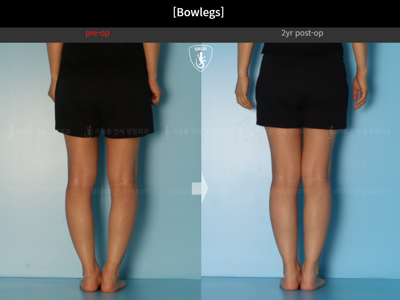 Before and after adult bowlegs, case 20942169, image 9, Dr. Donghoon institute (DALRI)