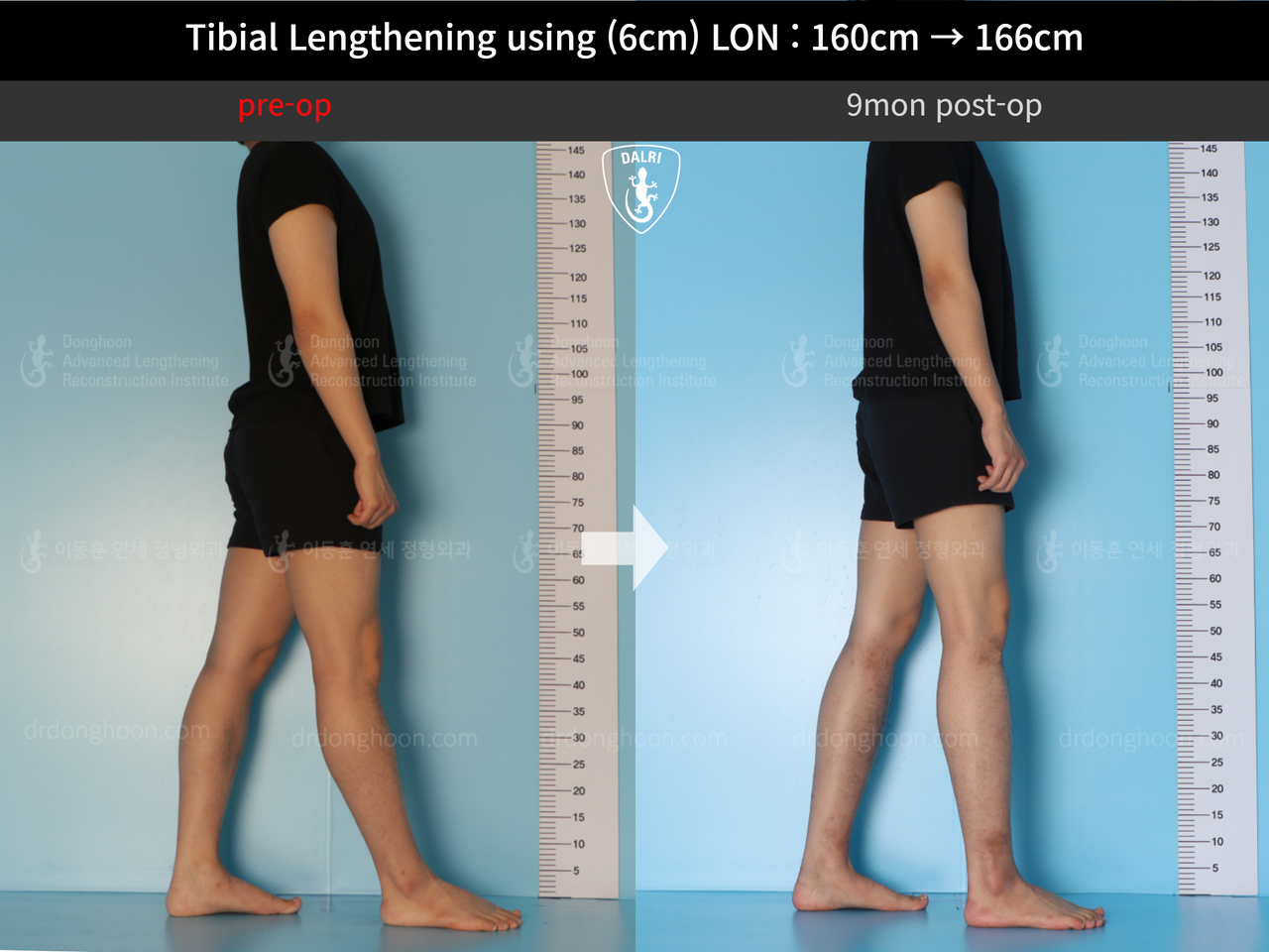 Before and after cll lon, case 13326359, image 3, Dr. Donghoon institute (DALRI)