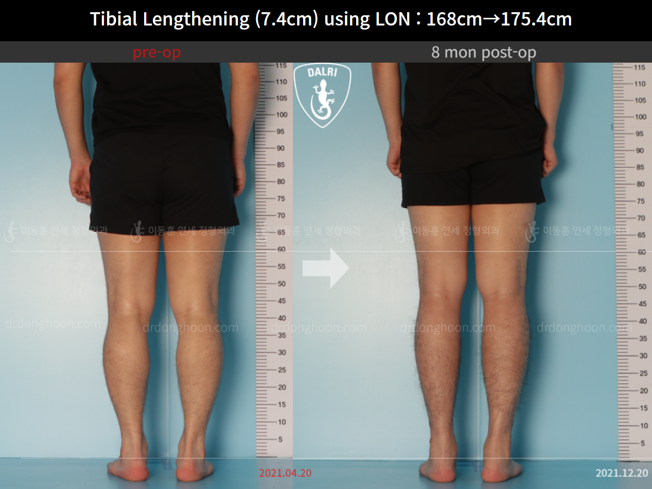 Before and after cll lon, case 9188051, image 6, Dr. Donghoon institute (DALRI)