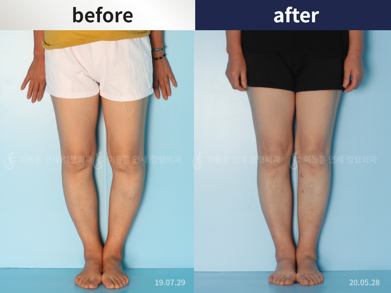 Before and after flexion deformity, case 5987528, image 3, Dr. Donghoon institute (DALRI)