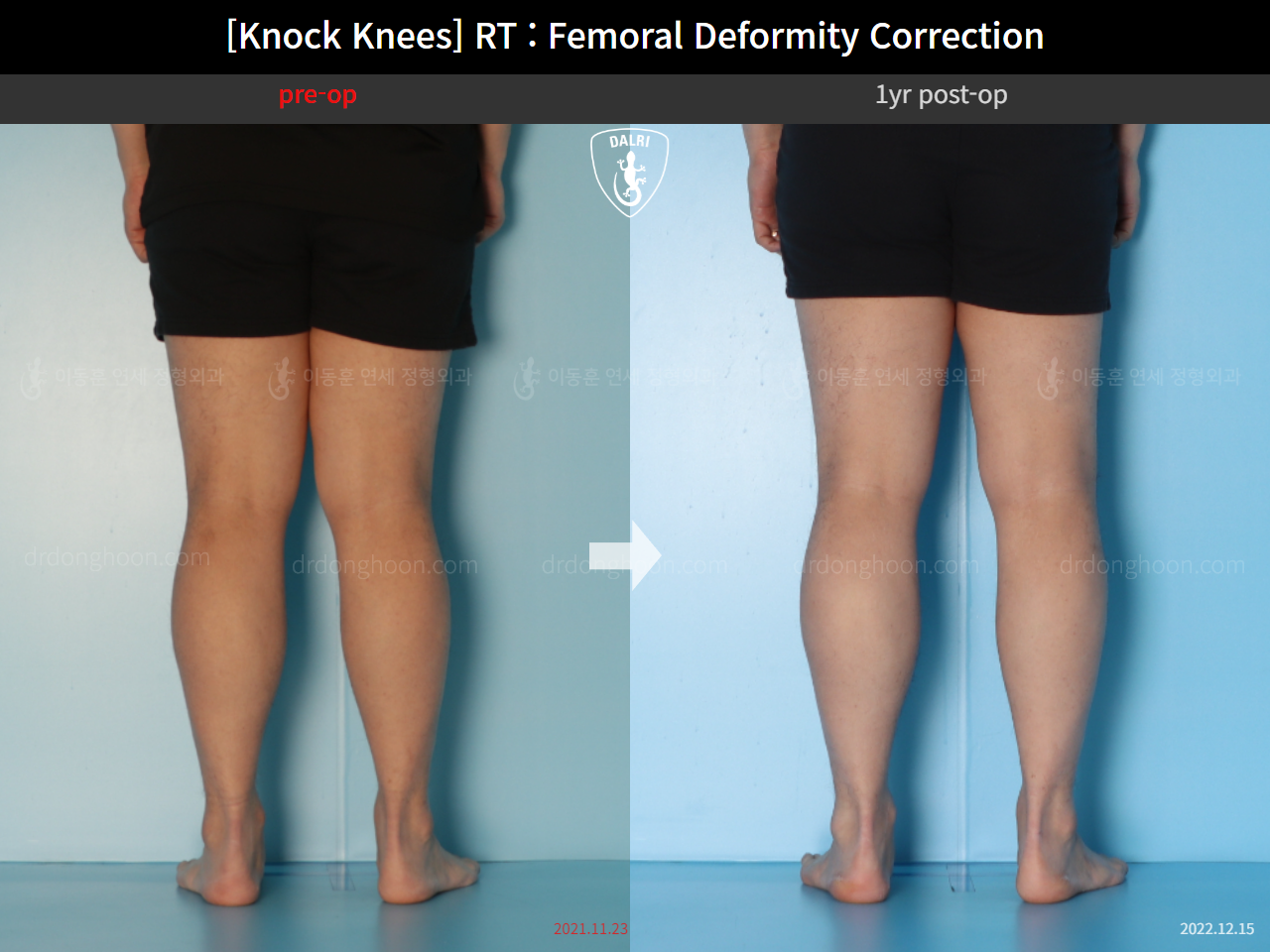 Before and after adult knock knees, case 15950751, image 12, Dr. Donghoon institute (DALRI)