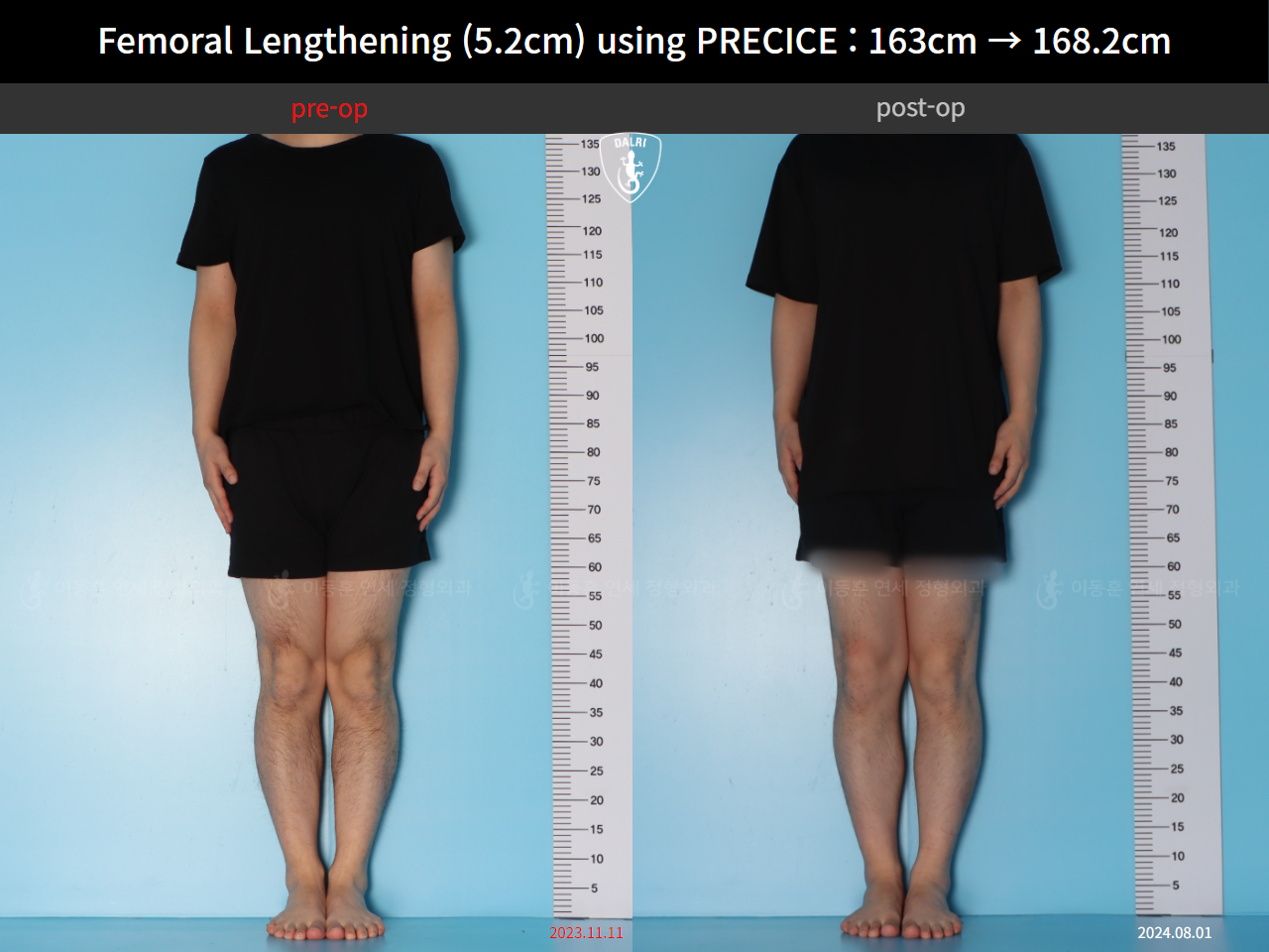 Before and after cll precice, case 55585697, image 1, Dr. Donghoon institute (DALRI)