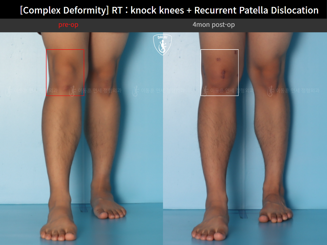 Before and after adult knock knees, case 125841800, image 10, Dr. Donghoon institute (DALRI)