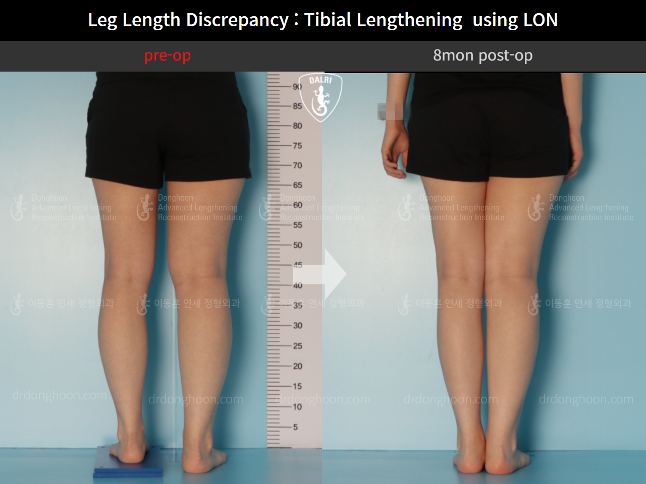 Before and after adult lld, case 10477860, image 5, Dr. Donghoon institute (DALRI)