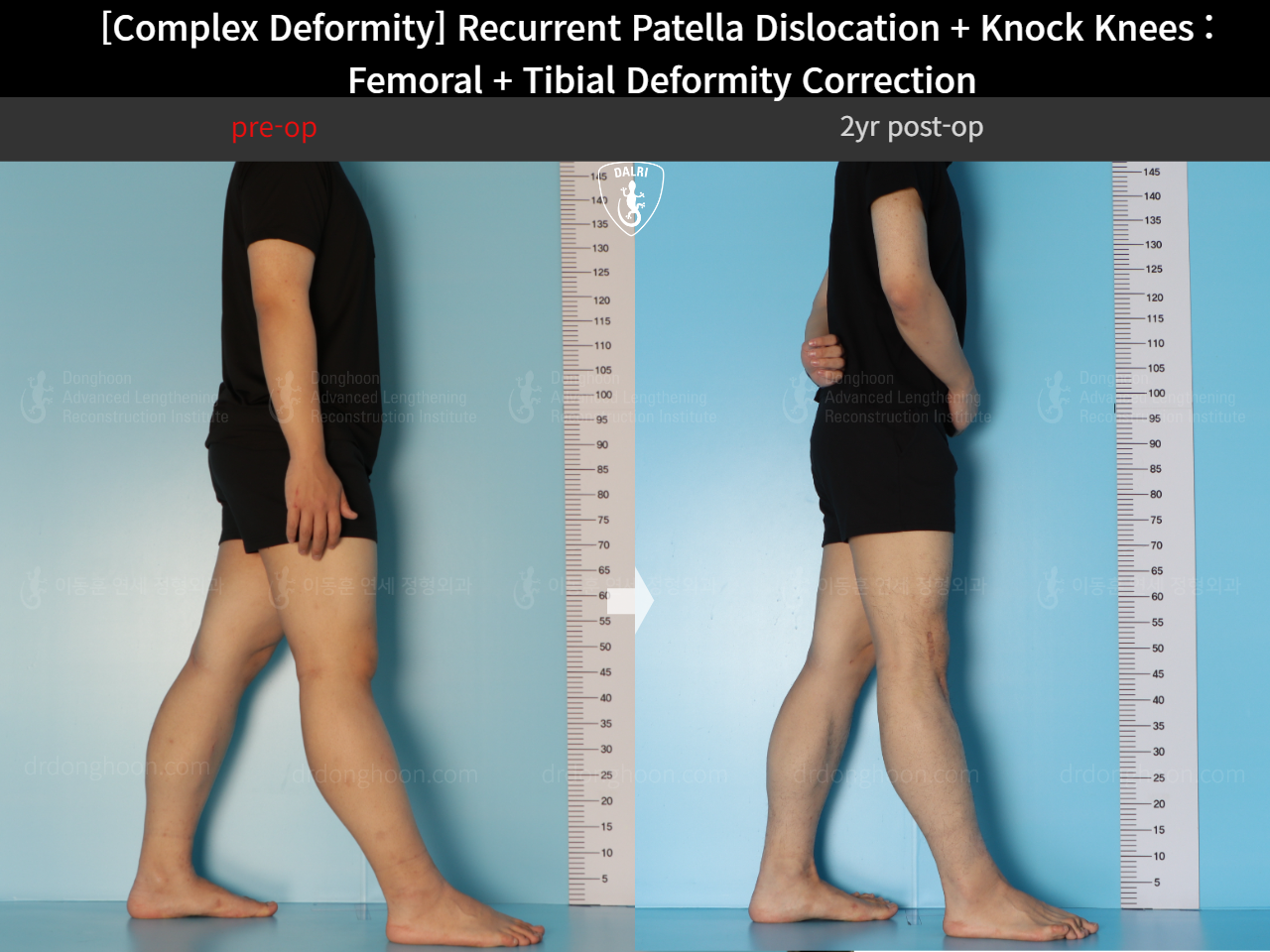 Before and after complex deformity, case 17434919, image 4, Dr. Donghoon institute (DALRI)