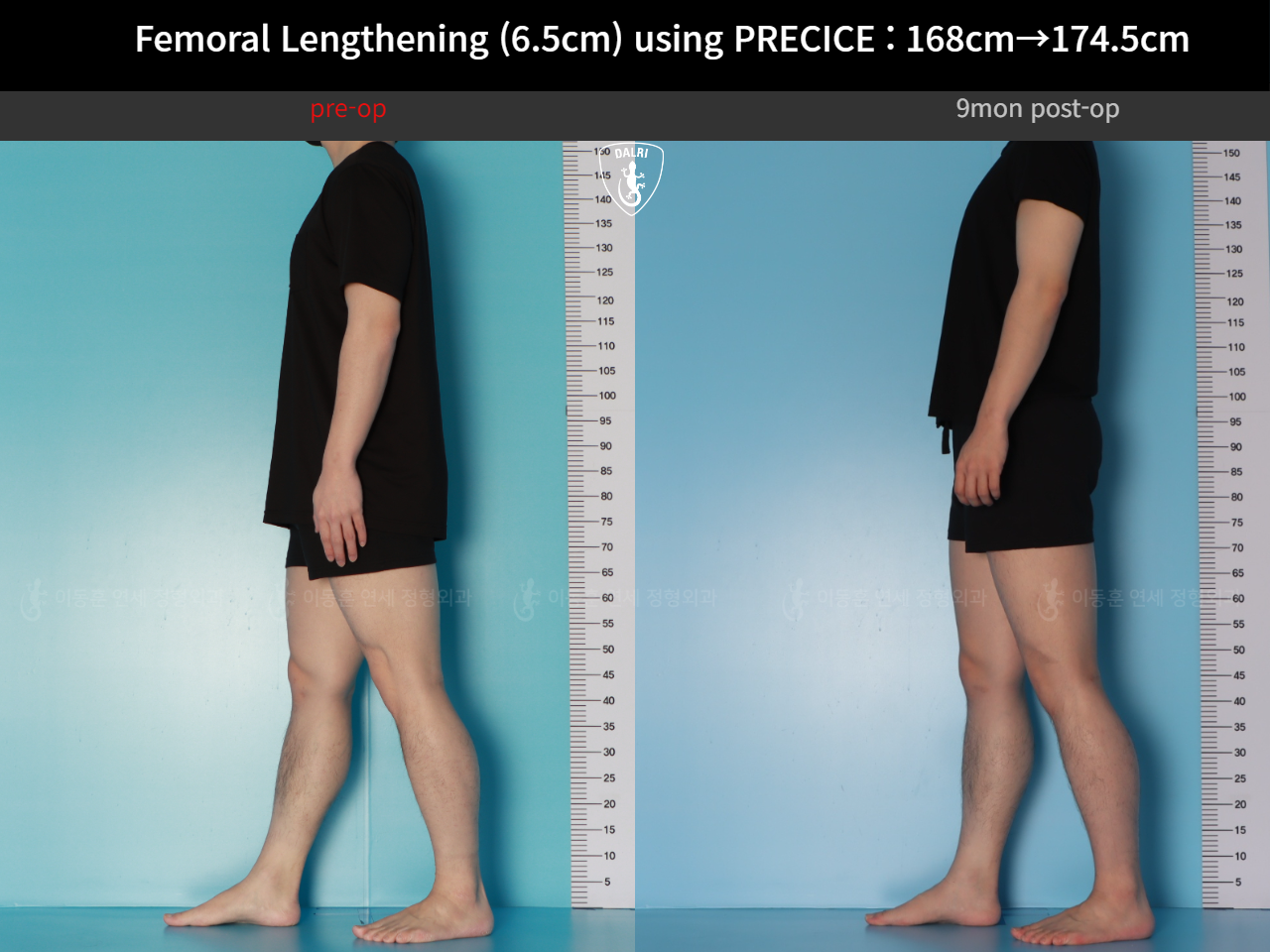 Before and after cll precice, case 123911358, image 4, Dr. Donghoon institute (DALRI)