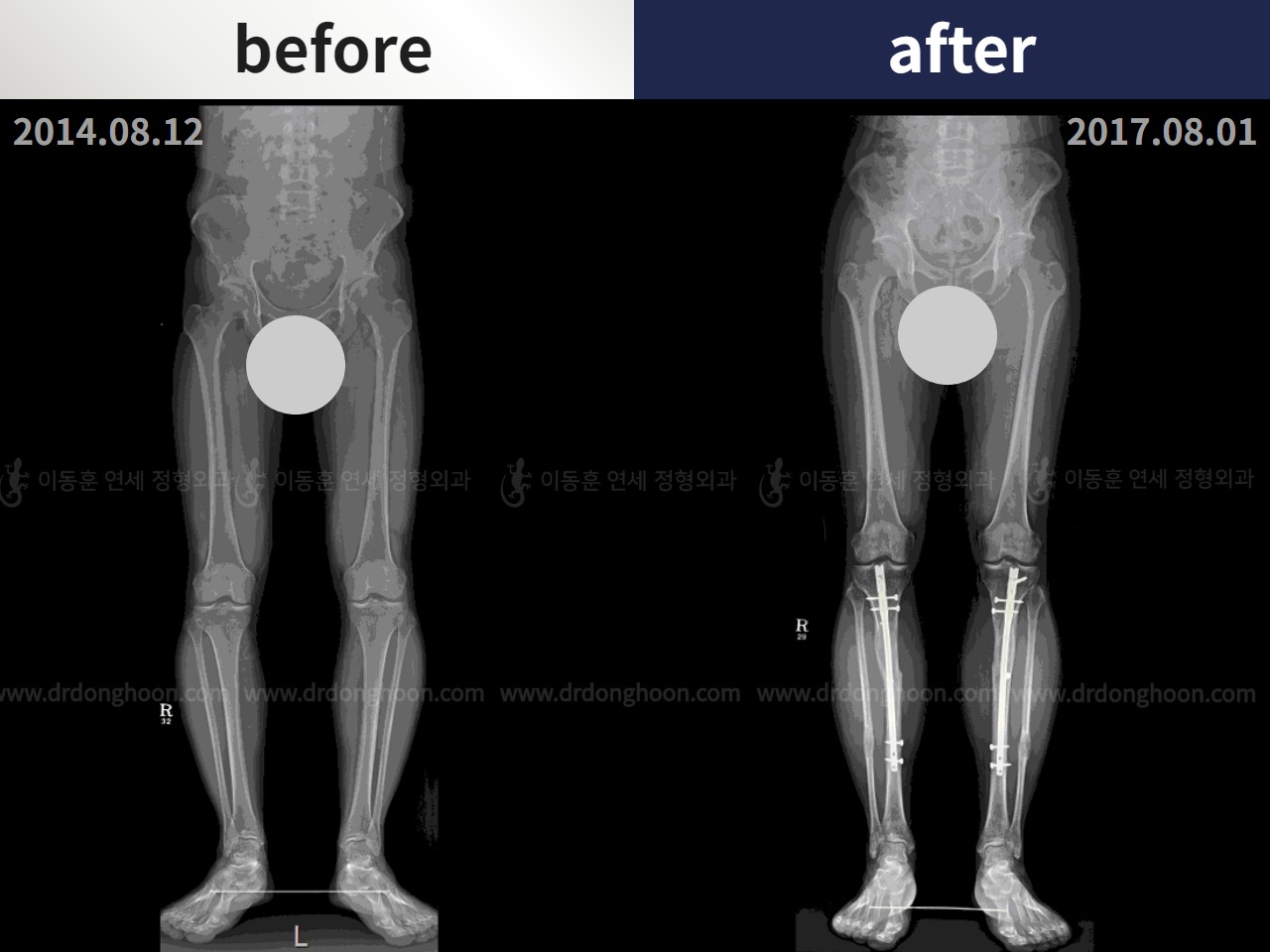Before and after adult bowlegs, case 4311099, image 3, Dr. Donghoon institute (DALRI)