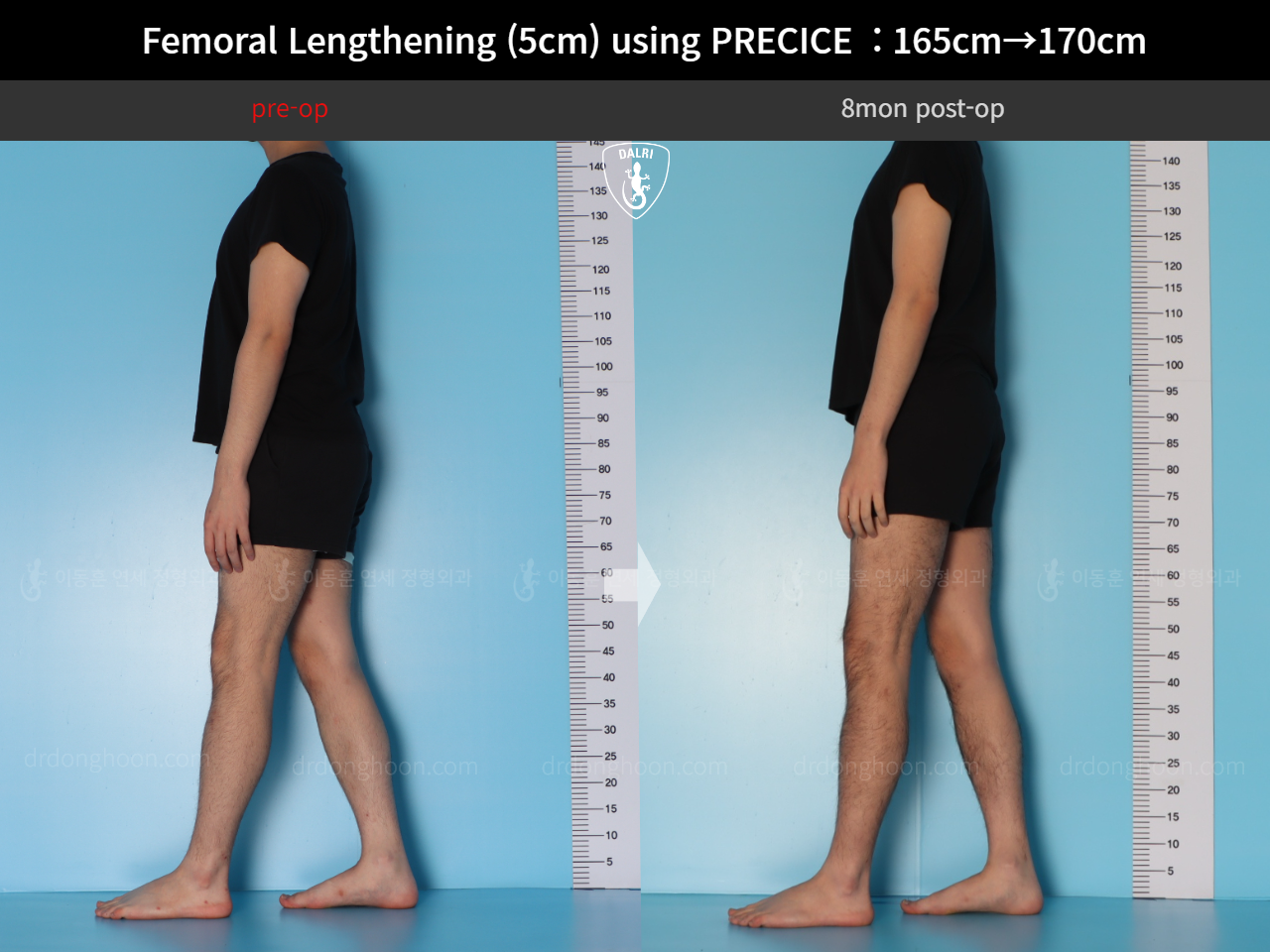 Before and after cll precice, case 18356944, image 3, Dr. Donghoon institute (DALRI)