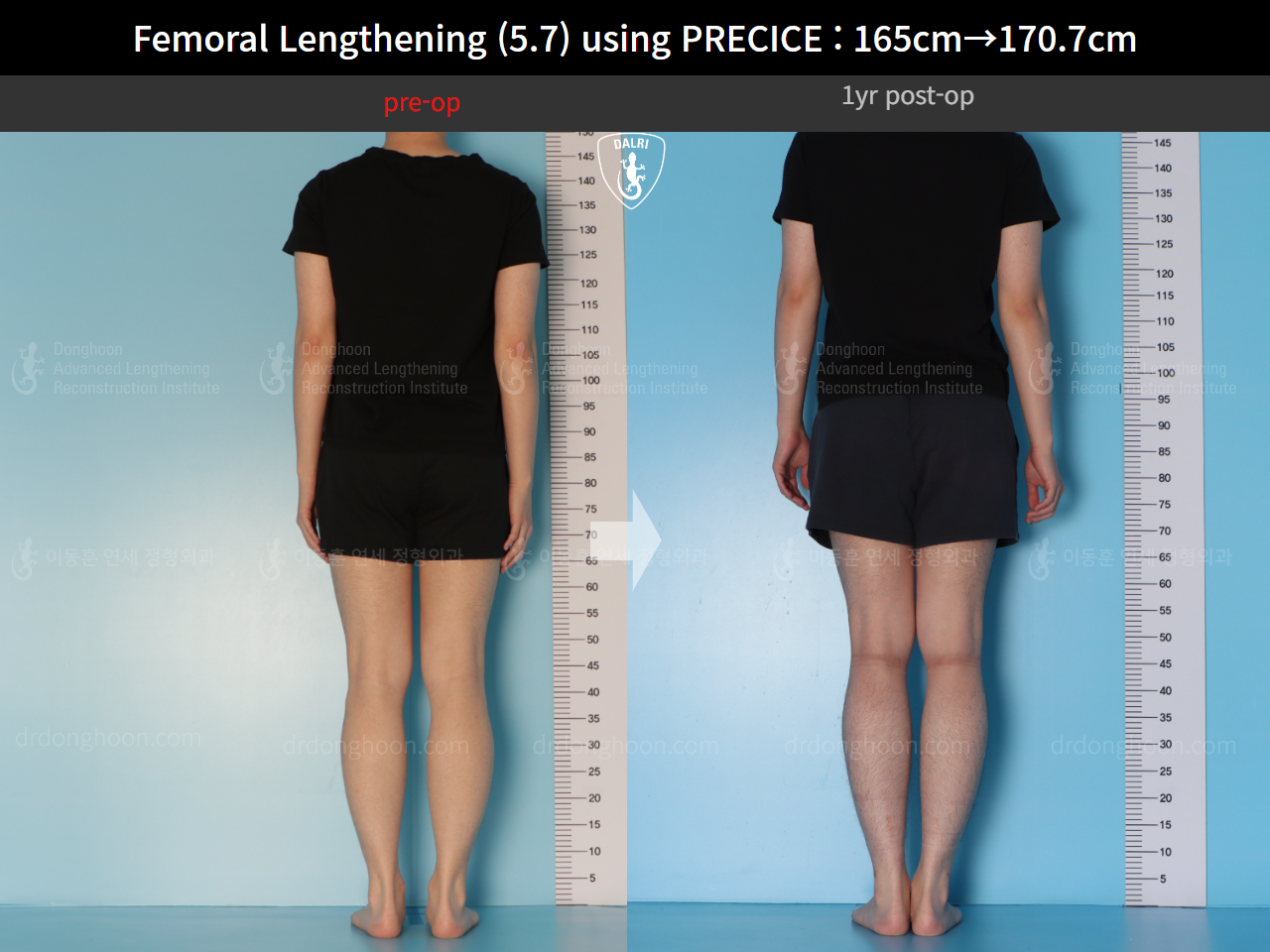Before and after cll precice, case 15417090, image 2, Dr. Donghoon institute (DALRI)