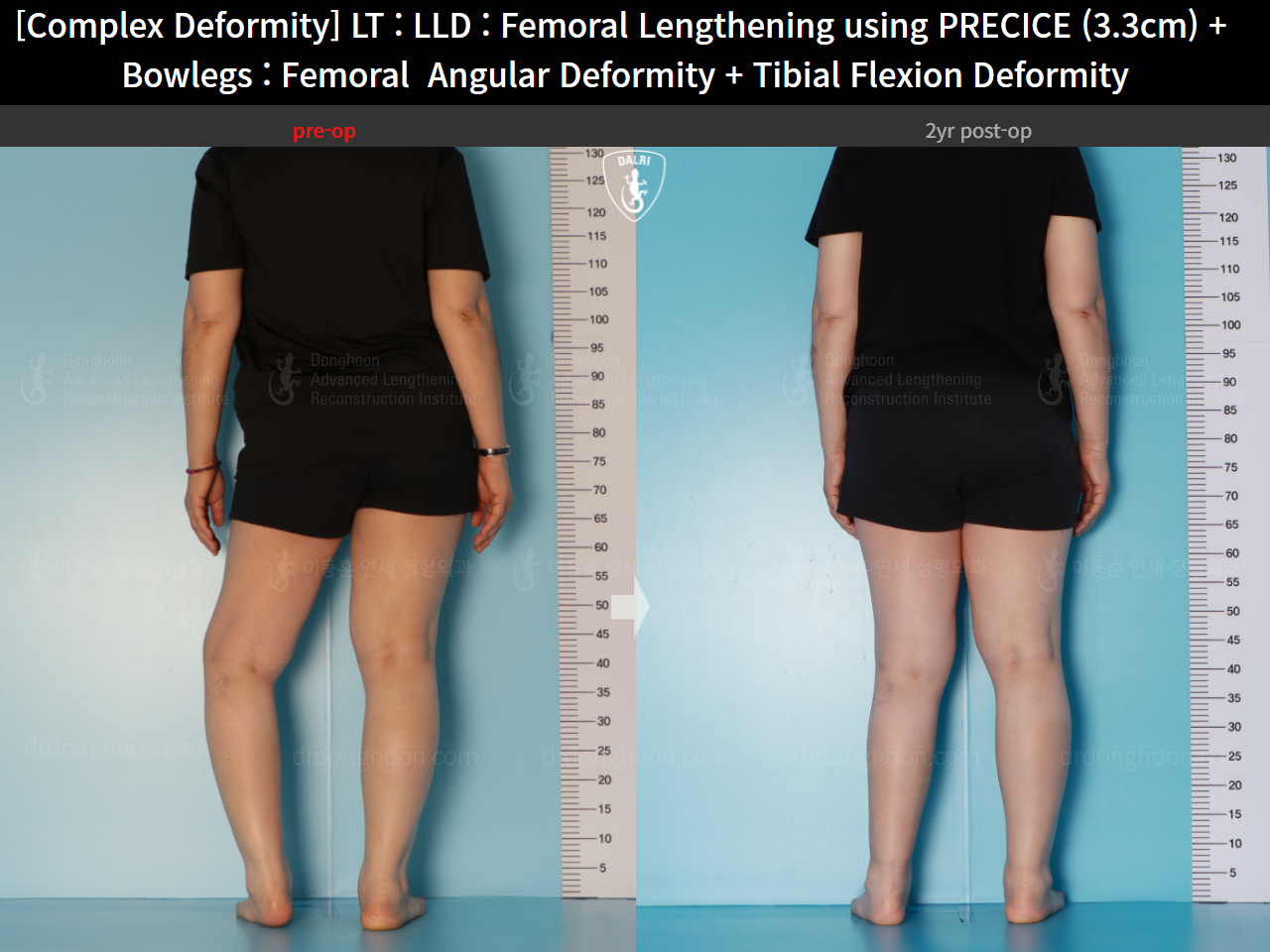 Before and after osteotomy for knee osteoarthritis, case 16786712, image 9, Dr. Donghoon institute (DALRI)