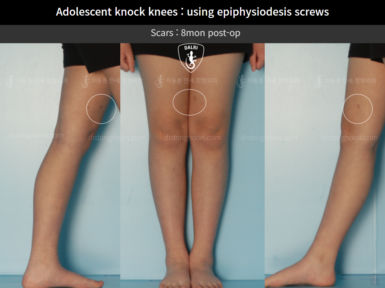Before and after paediatric & adolescent knock knees, case 10297056, image 5, Dr. Donghoon institute (DALRI)