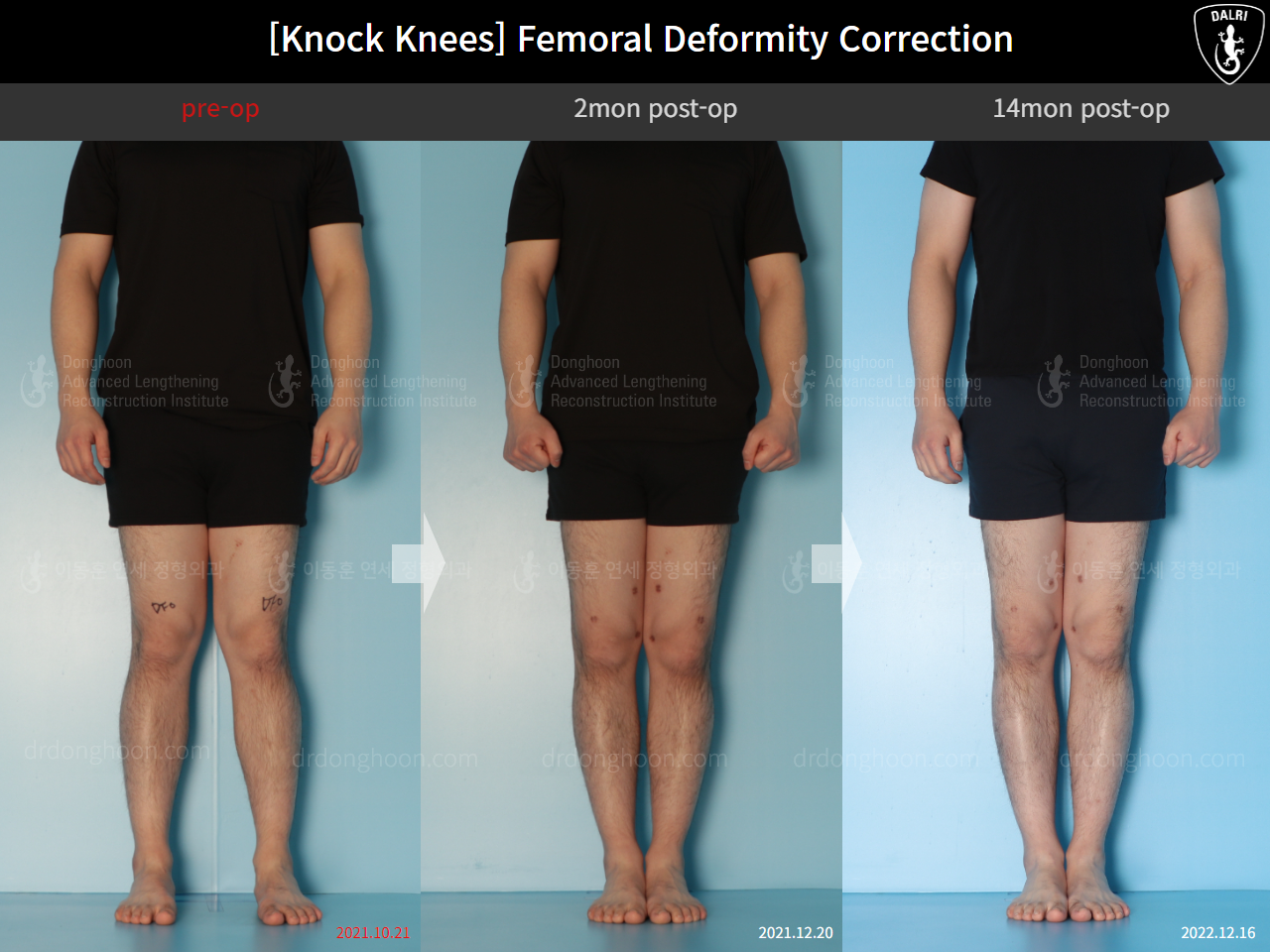 Before and after adult knock knees, case 15816319, image 1, Dr. Donghoon institute (DALRI)