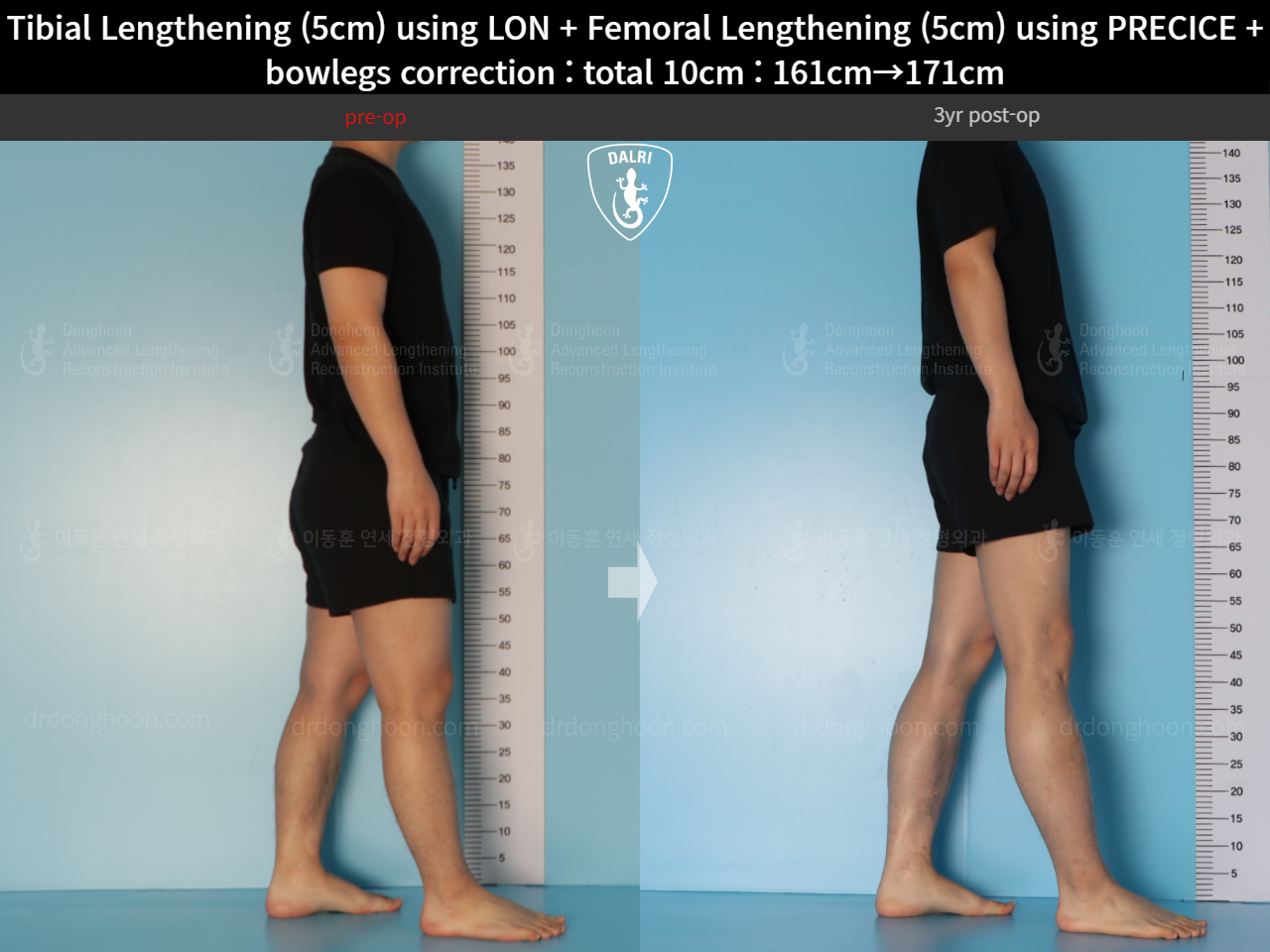 Before and after cll + deformity correction, case 22208435, image 6, Dr. Donghoon institute (DALRI)