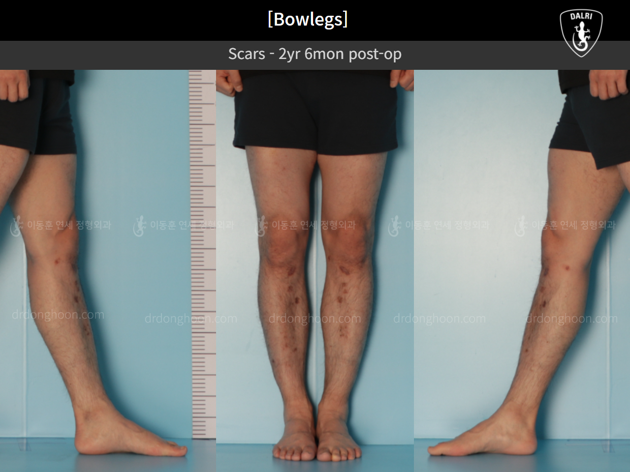 Before and after adult bowlegs, case 11037119, image 8, Dr. Donghoon institute (DALRI)