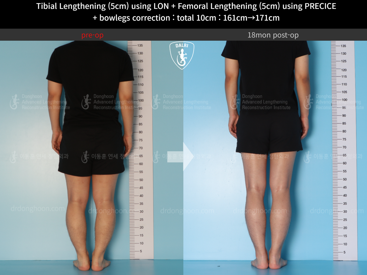 Before and after cll + deformity correction, case 13660857, image 4, Dr. Donghoon institute (DALRI)