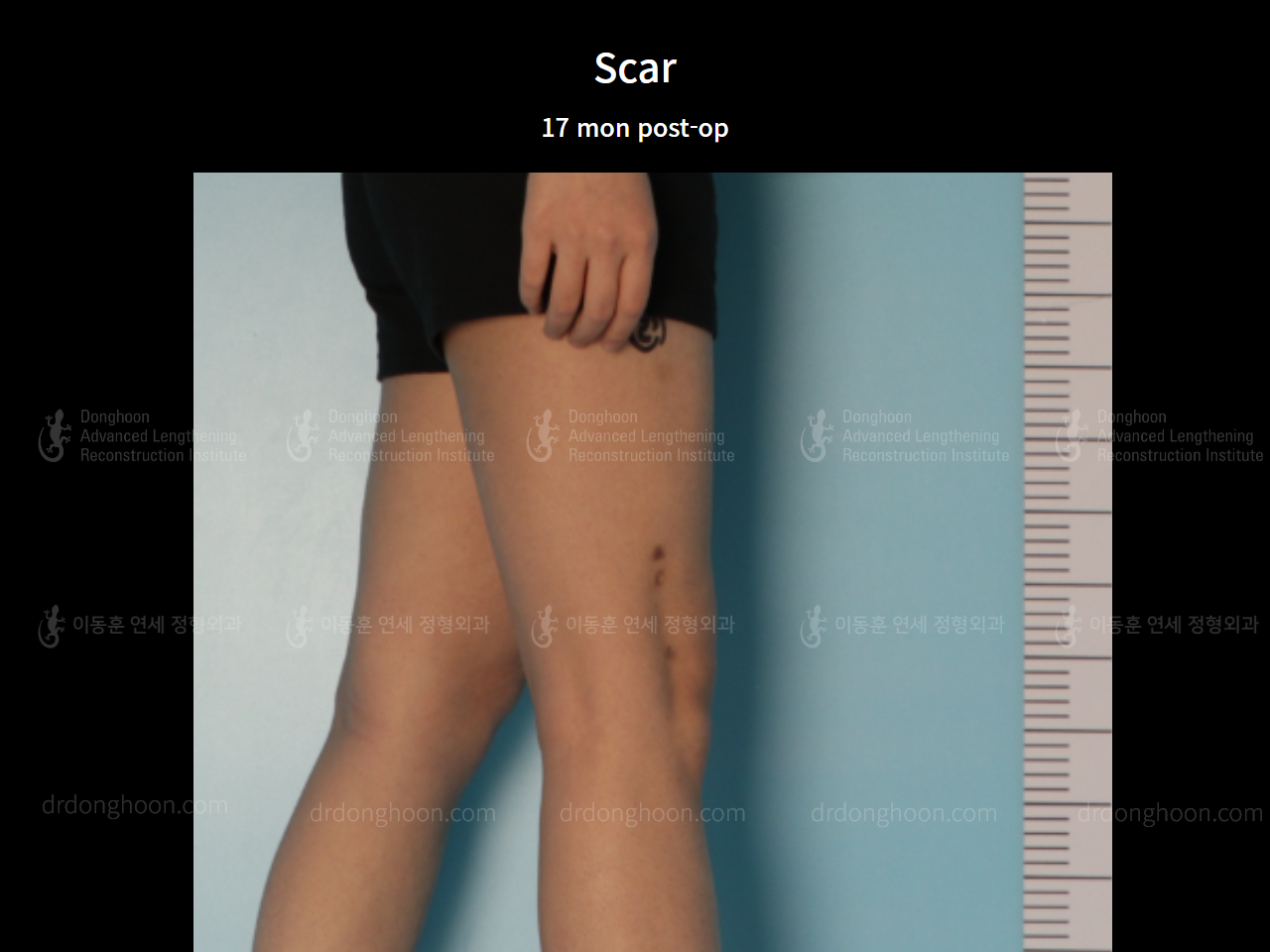 Before and after adult lld, case 8385191, image 5, Dr. Donghoon institute (DALRI)