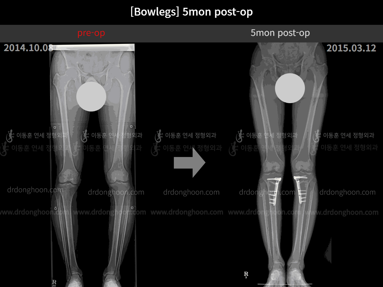 Before and after adult bowlegs, case 4311030, image 5, Dr. Donghoon institute (DALRI)