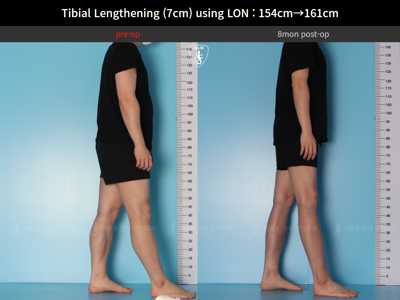 Before and after cll lon, case 127519935, image 7, Dr. Donghoon institute (DALRI)