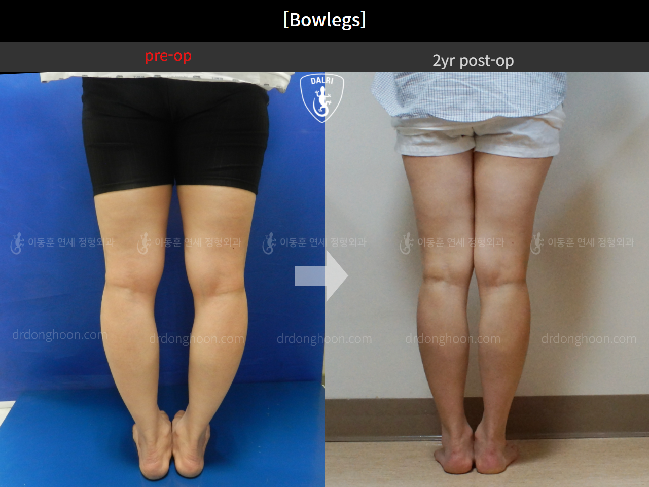 Before and after adult bowlegs, case 4310967, image 3, Dr. Donghoon institute (DALRI)