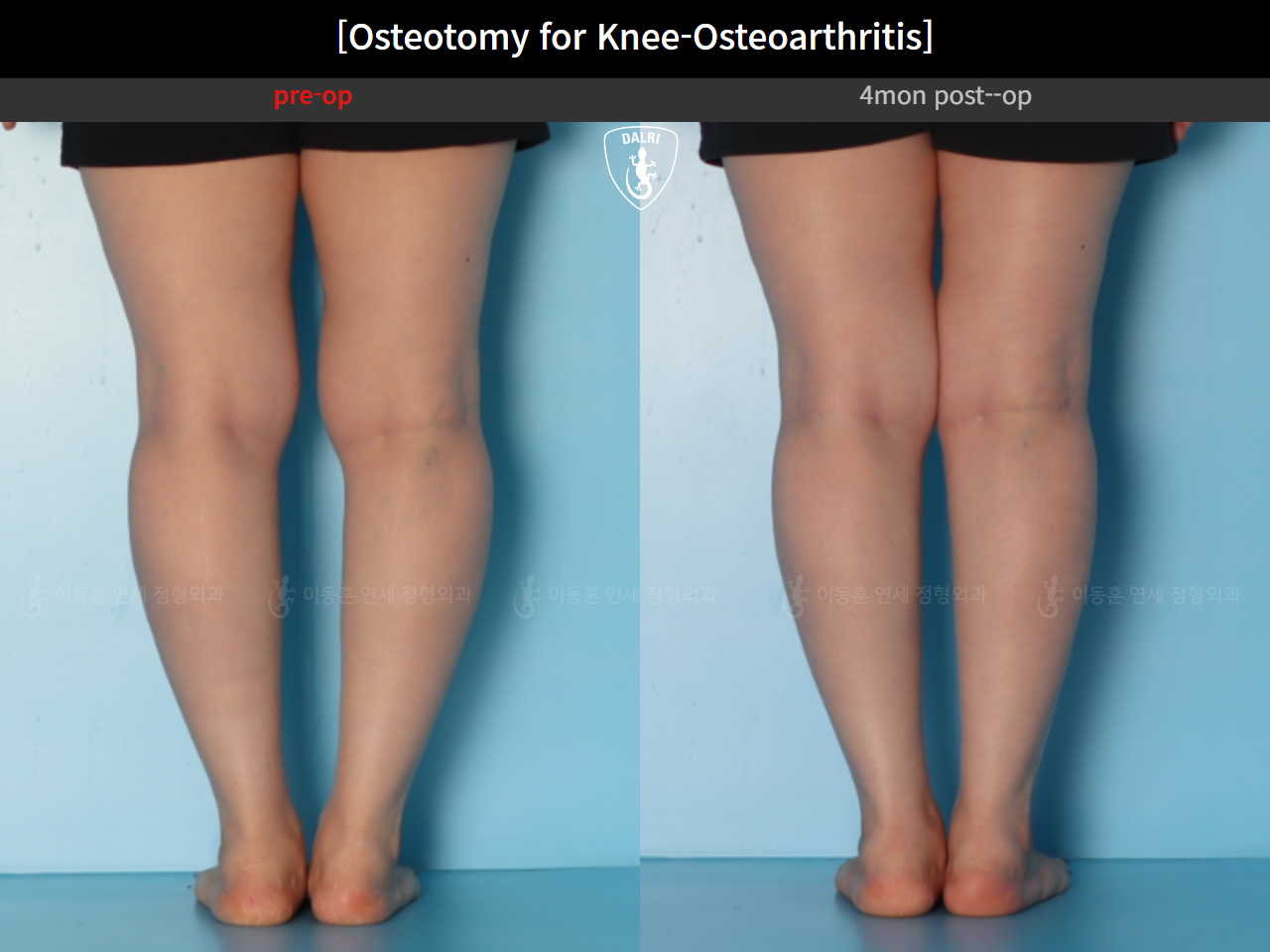 Before and after osteotomy for knee osteoarthritis, case 39778471, image 11, Dr. Donghoon institute (DALRI)