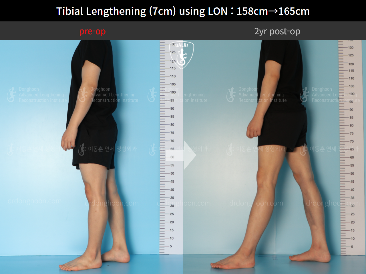 Before and after cll lon, case 9325768, image 4, Dr. Donghoon institute (DALRI)