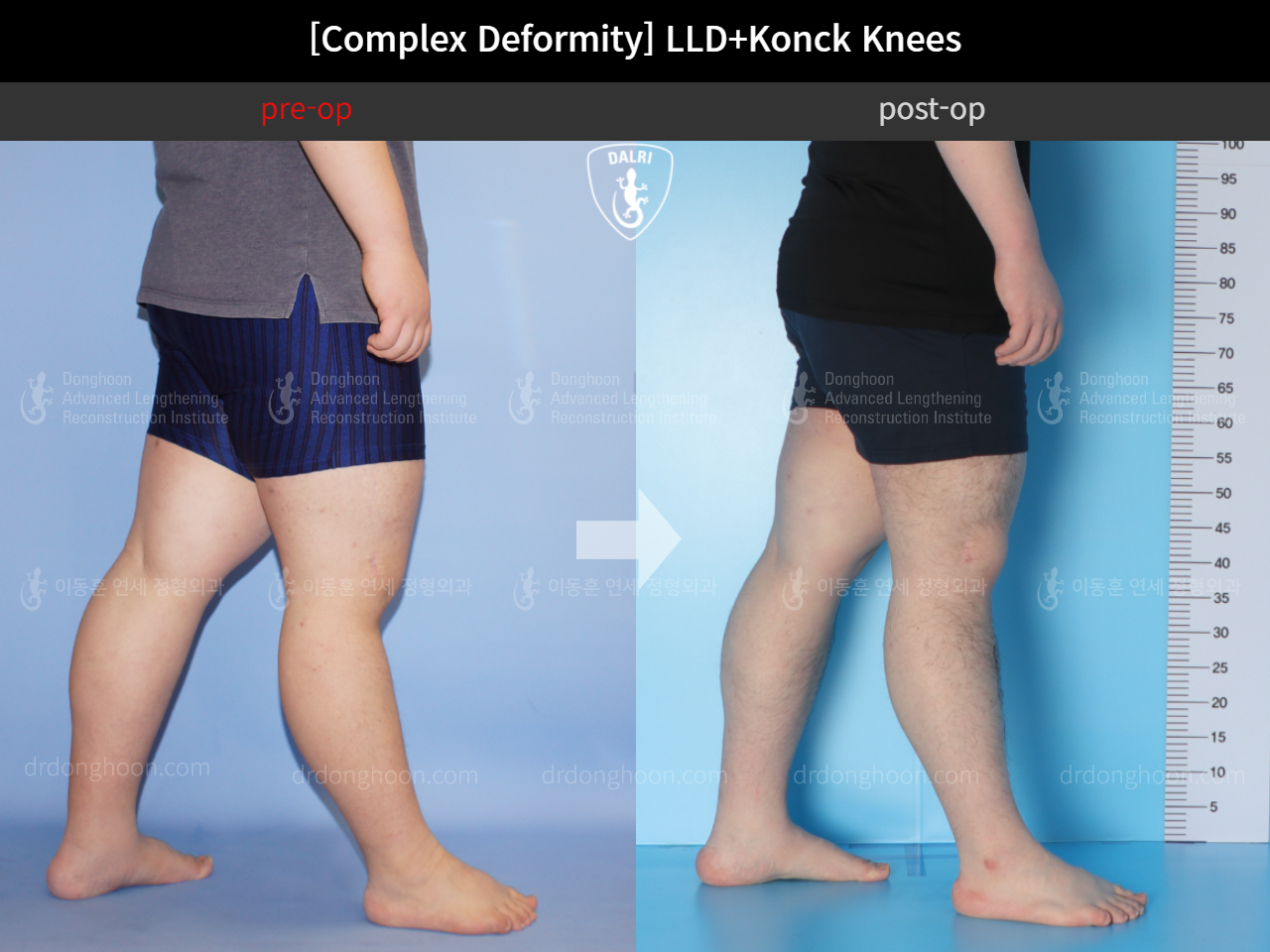 Before and after adult lld, case 10564254, image 6, Dr. Donghoon institute (DALRI)