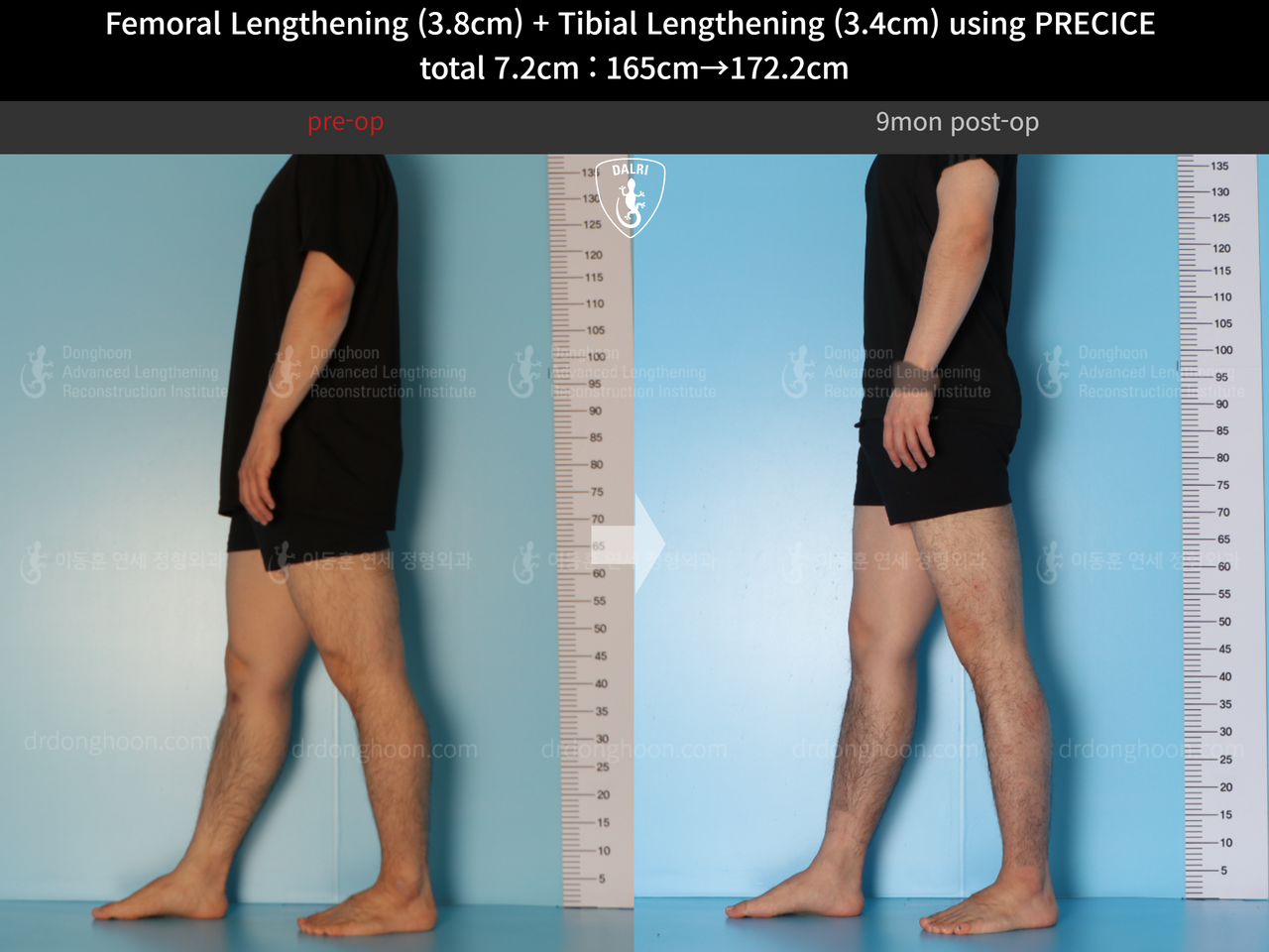 Before and after cll precice, case 14220657, image 6, Dr. Donghoon institute (DALRI)