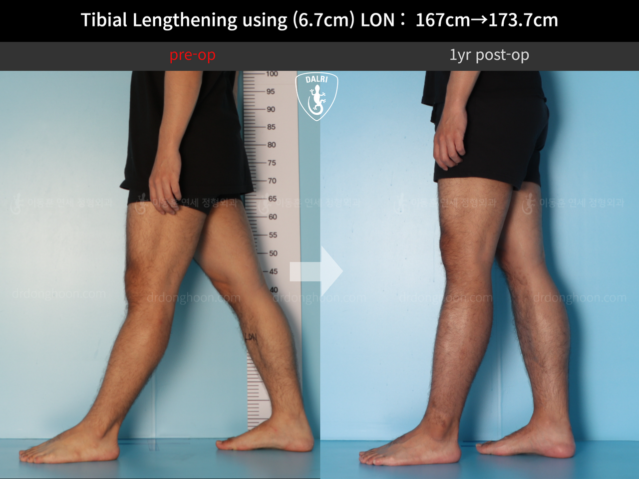 Before and after cll lon, case 12426969, image 8, Dr. Donghoon institute (DALRI)