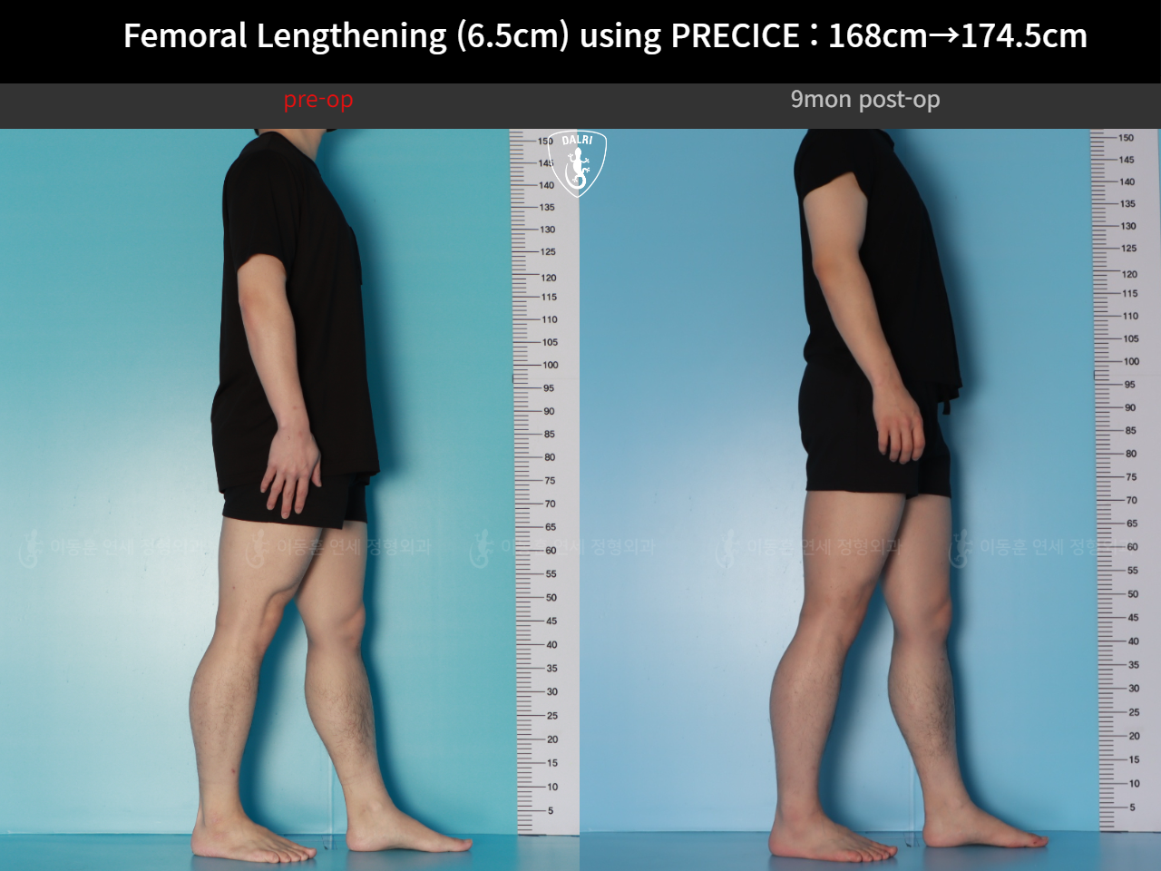 Before and after cll precice, case 123911358, image 6, Dr. Donghoon institute (DALRI)