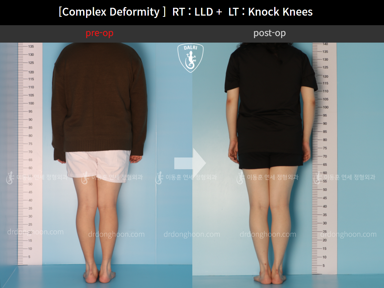Before and after adult lld, case 10524998, image 4, Dr. Donghoon institute (DALRI)
