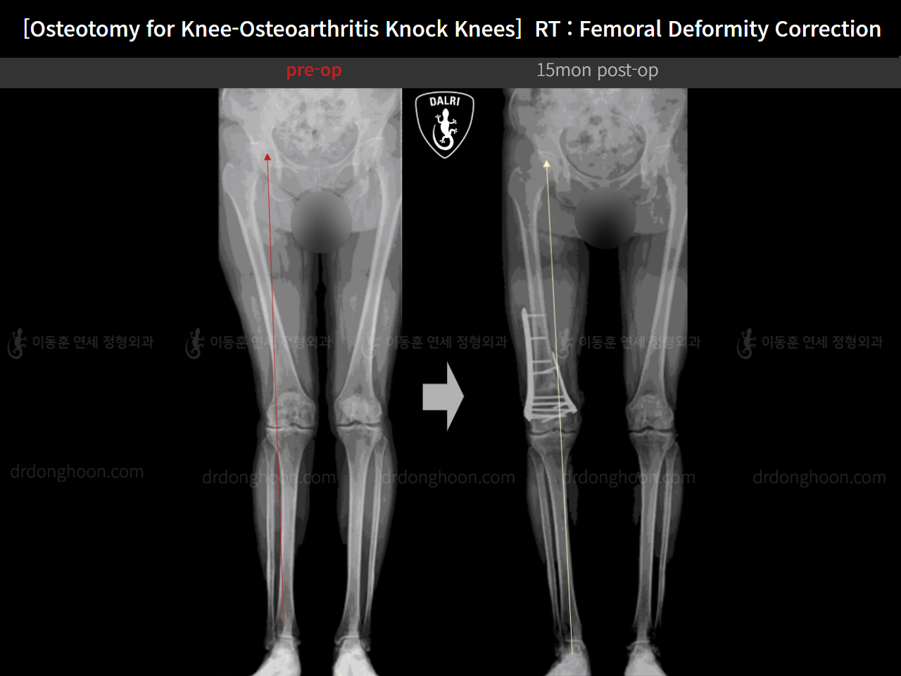 Before and after osteotomy for knee osteoarthritis, case 14462707, image 10, Dr. Donghoon institute (DALRI)