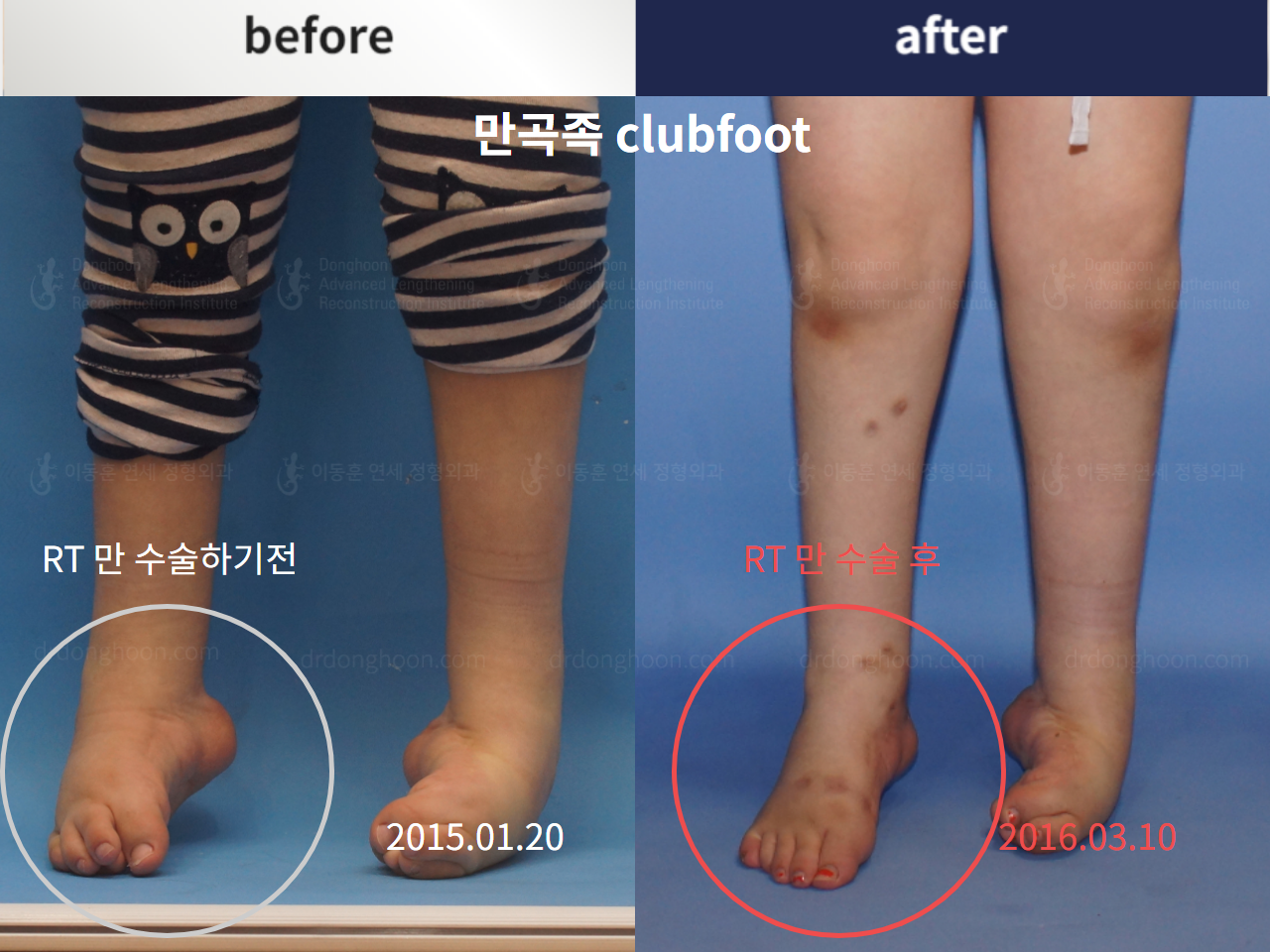 Before and after paediatric congenital condition, case 4304688, image 1, Dr. Donghoon institute (DALRI)