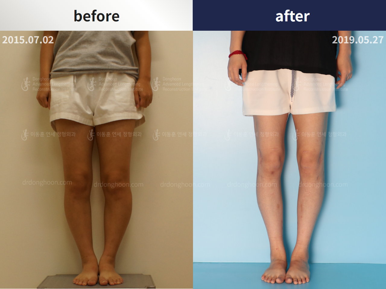 Before and after congenital condition, case 4304651, image 1, Dr. Donghoon institute (DALRI)