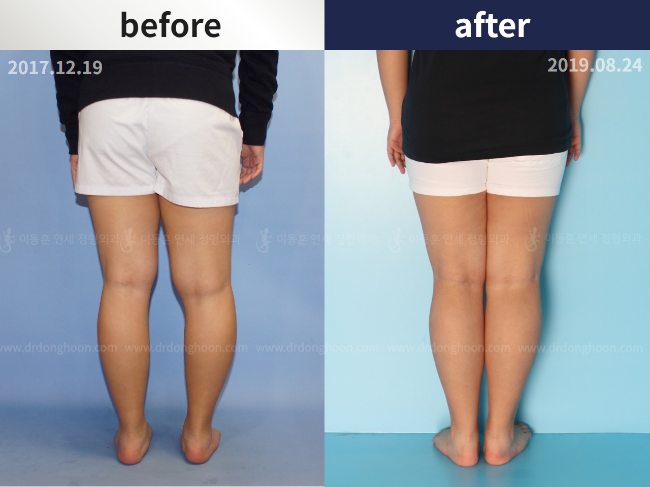 Before and after paediatric & adolescent bowlegs, case 4320272, image 2, Dr. Donghoon institute (DALRI)