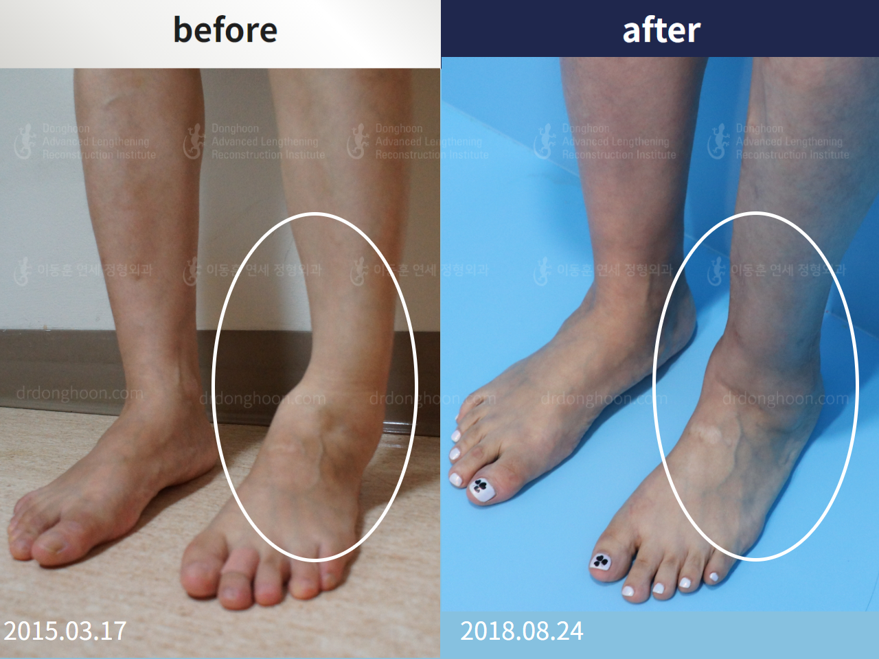 Before and after foot & ankle deformity, case 4248108, image 1, Dr. Donghoon institute (DALRI)