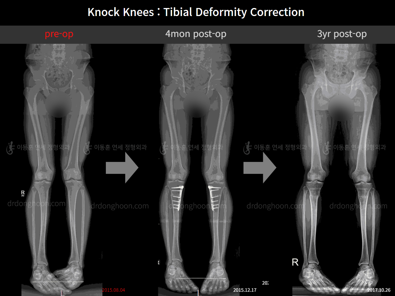 Before and after adult knock knees, case 11468369, image 5, Dr. Donghoon institute (DALRI)