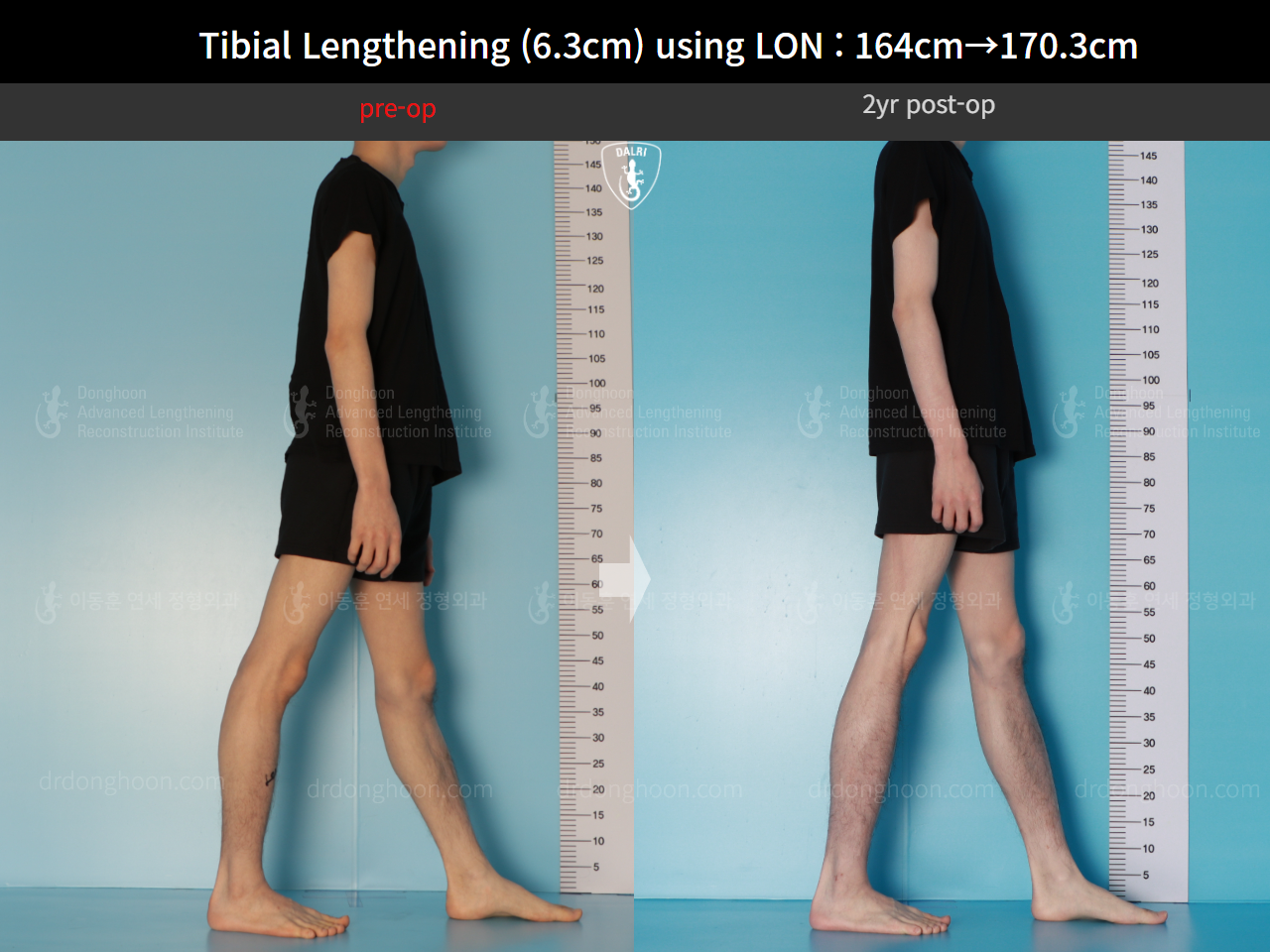 Before and after cll lon, case 16723608, image 6, Dr. Donghoon institute (DALRI)