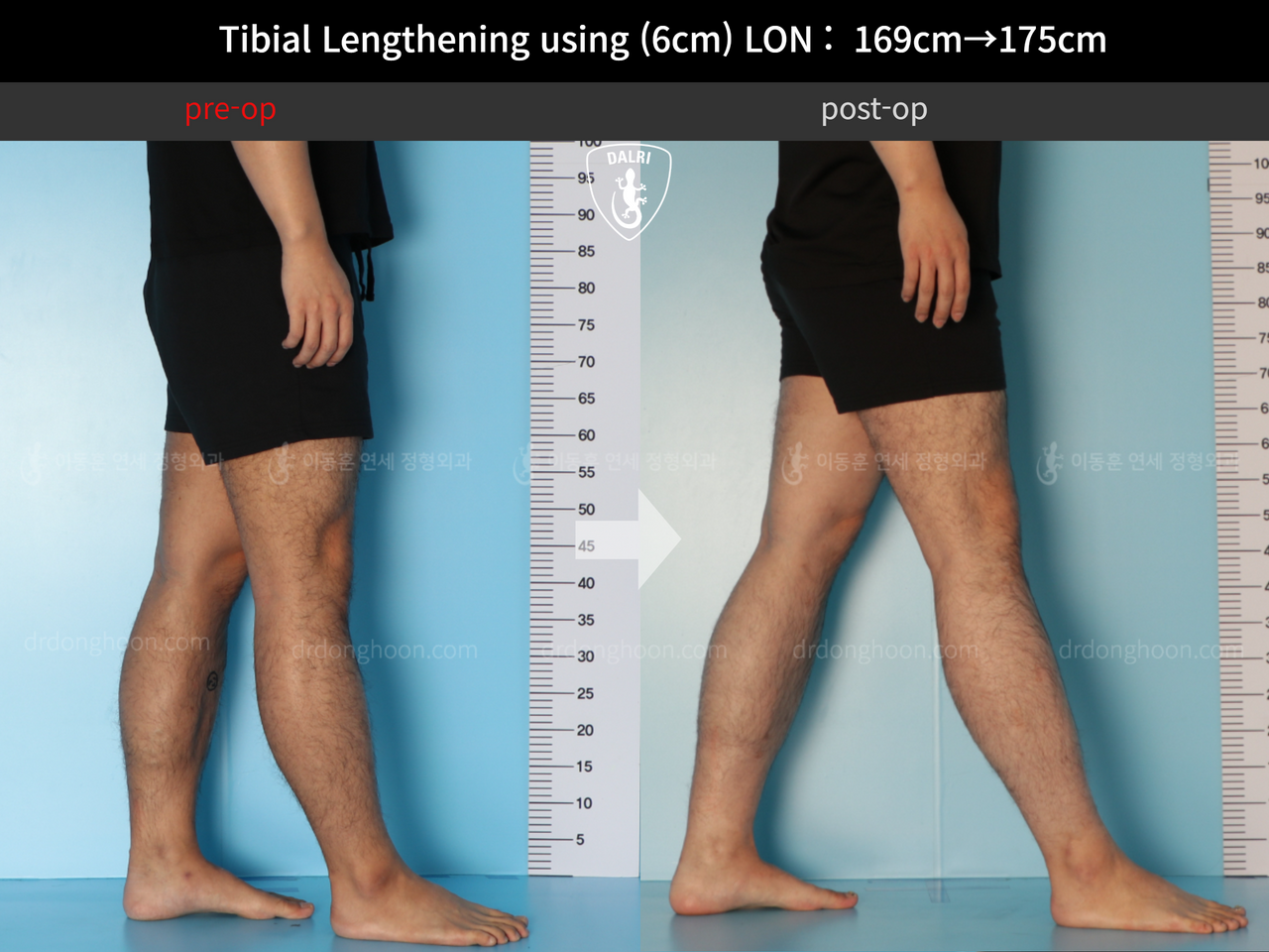 Before and after cll lon, case 12279515, image 7, Dr. Donghoon institute (DALRI)