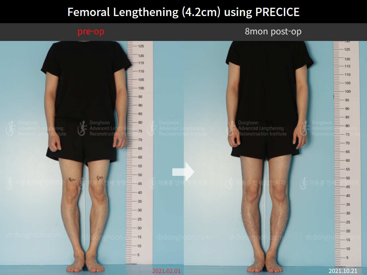 Before and after cll precice, case 8781700, image 1, Dr. Donghoon institute (DALRI)