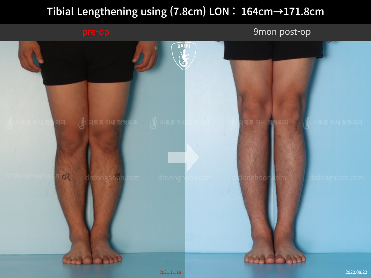 Before and after cll lon, case 12652002, image 5, Dr. Donghoon institute (DALRI)