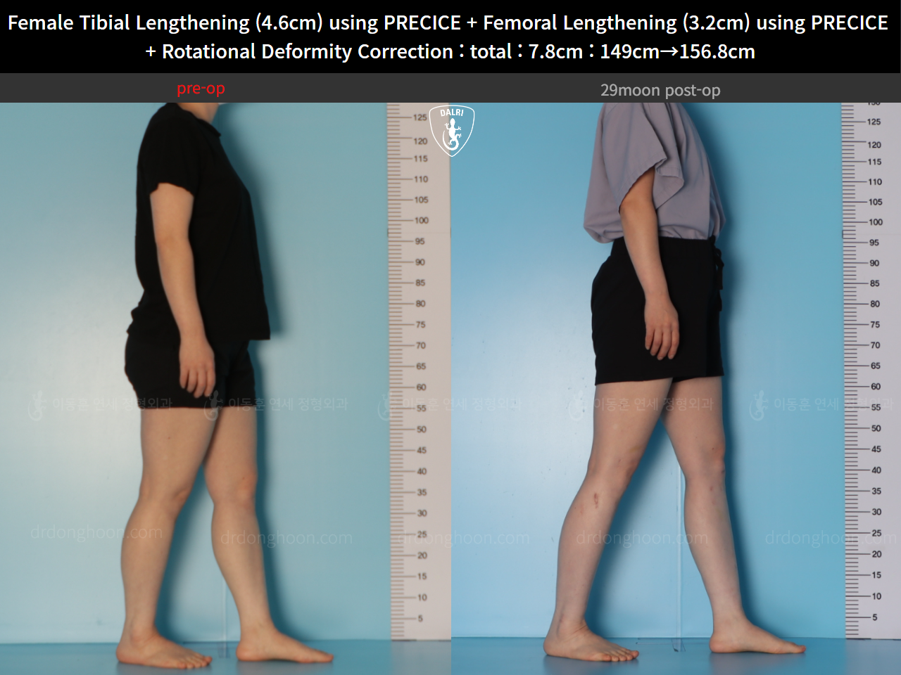 Before and after cll precice, case 123686647, image 7, Dr. Donghoon institute (DALRI)