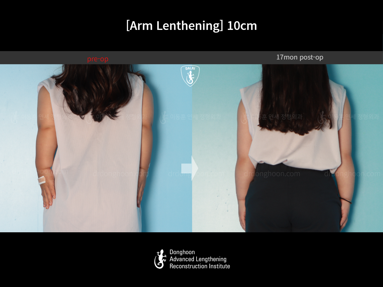 Before and after arm lengthening, case 17924395, image 4, Dr. Donghoon institute (DALRI)