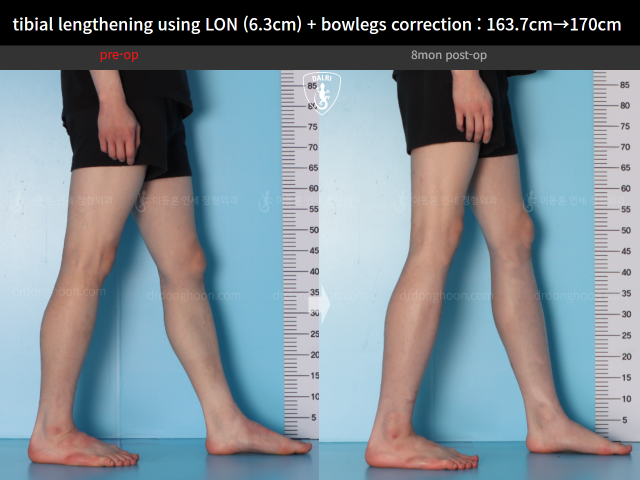 Before and after cll + deformity correction, case 16853829, image 12, Dr. Donghoon institute (DALRI)