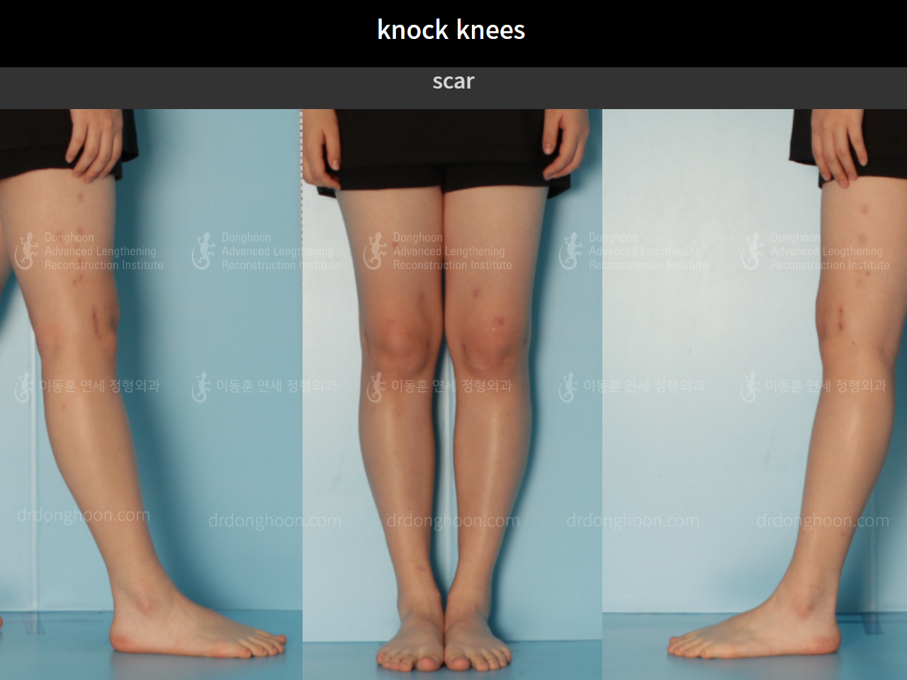 Before and after adult knock knees, case 9095996, image 5, Dr. Donghoon institute (DALRI)