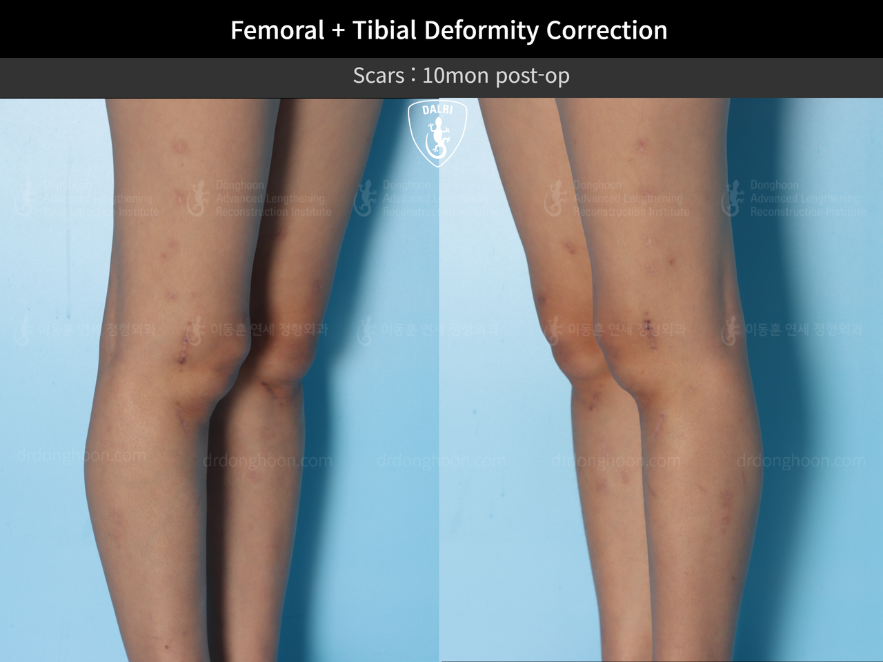 Before and after complex deformity, case 12860892, image 9, Dr. Donghoon institute (DALRI)