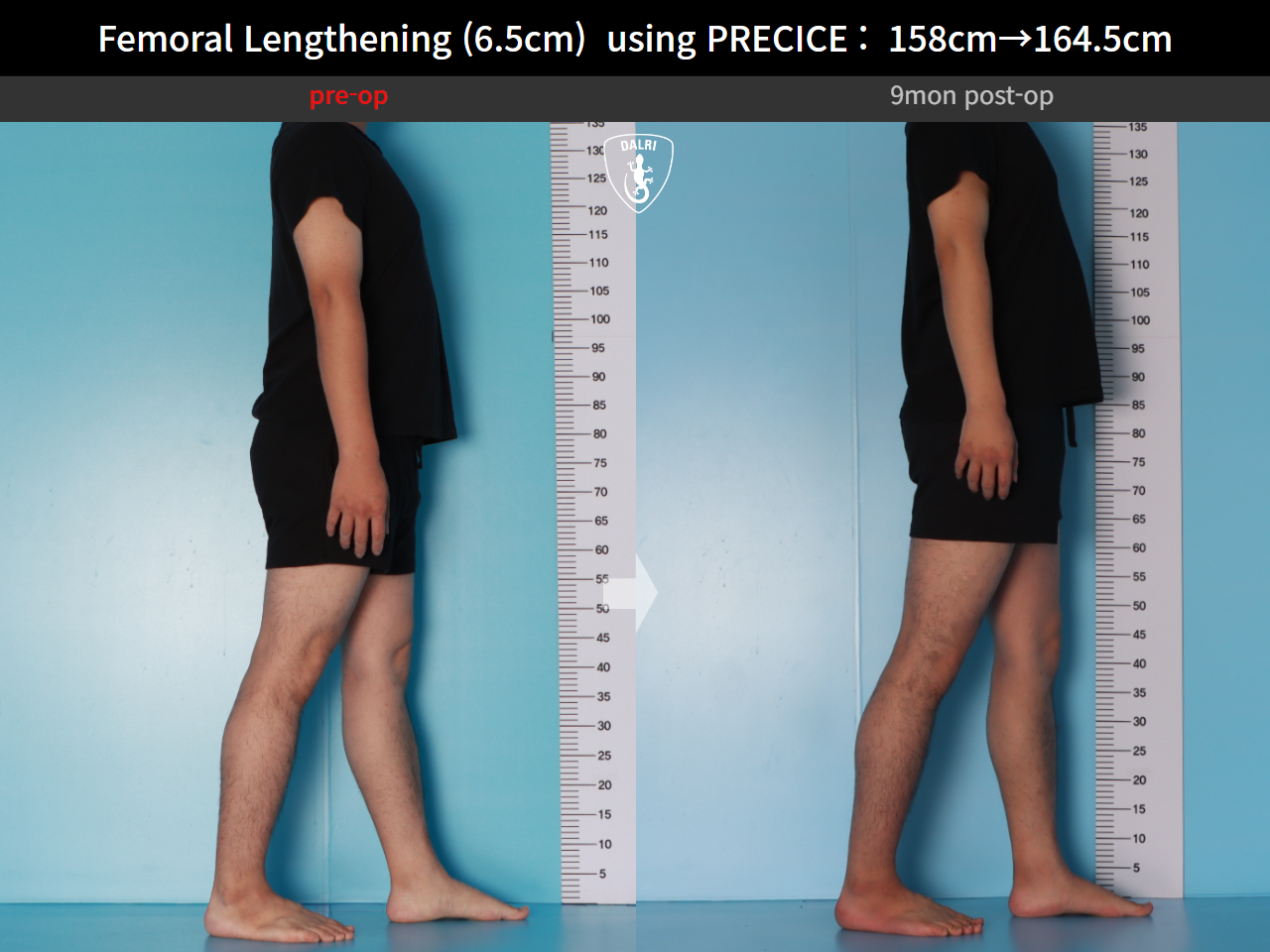 Before and after cll precice, case 28297898, image 6, Dr. Donghoon institute (DALRI)