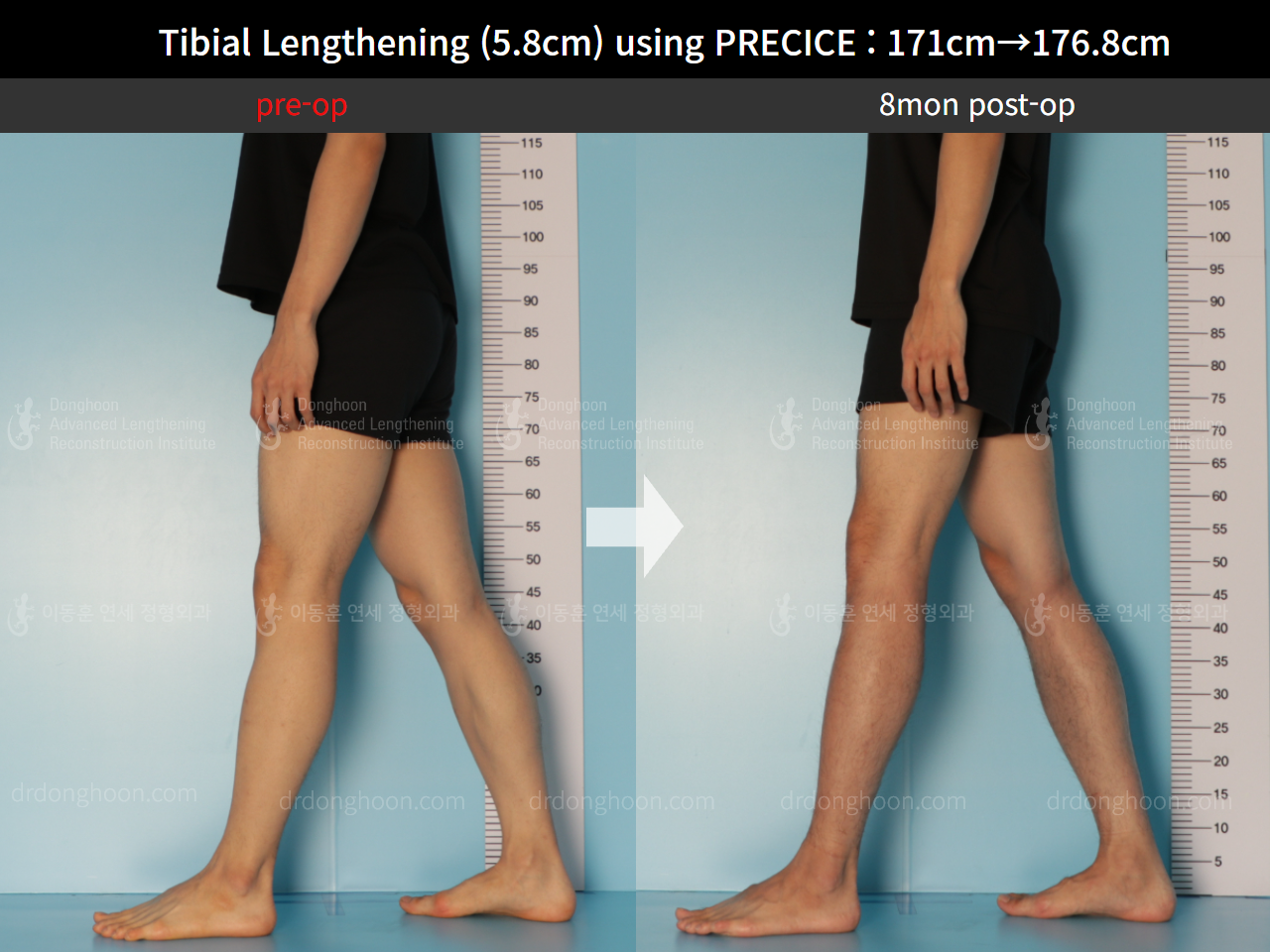 Before and after cll precice, case 8678696, image 8, Dr. Donghoon institute (DALRI)