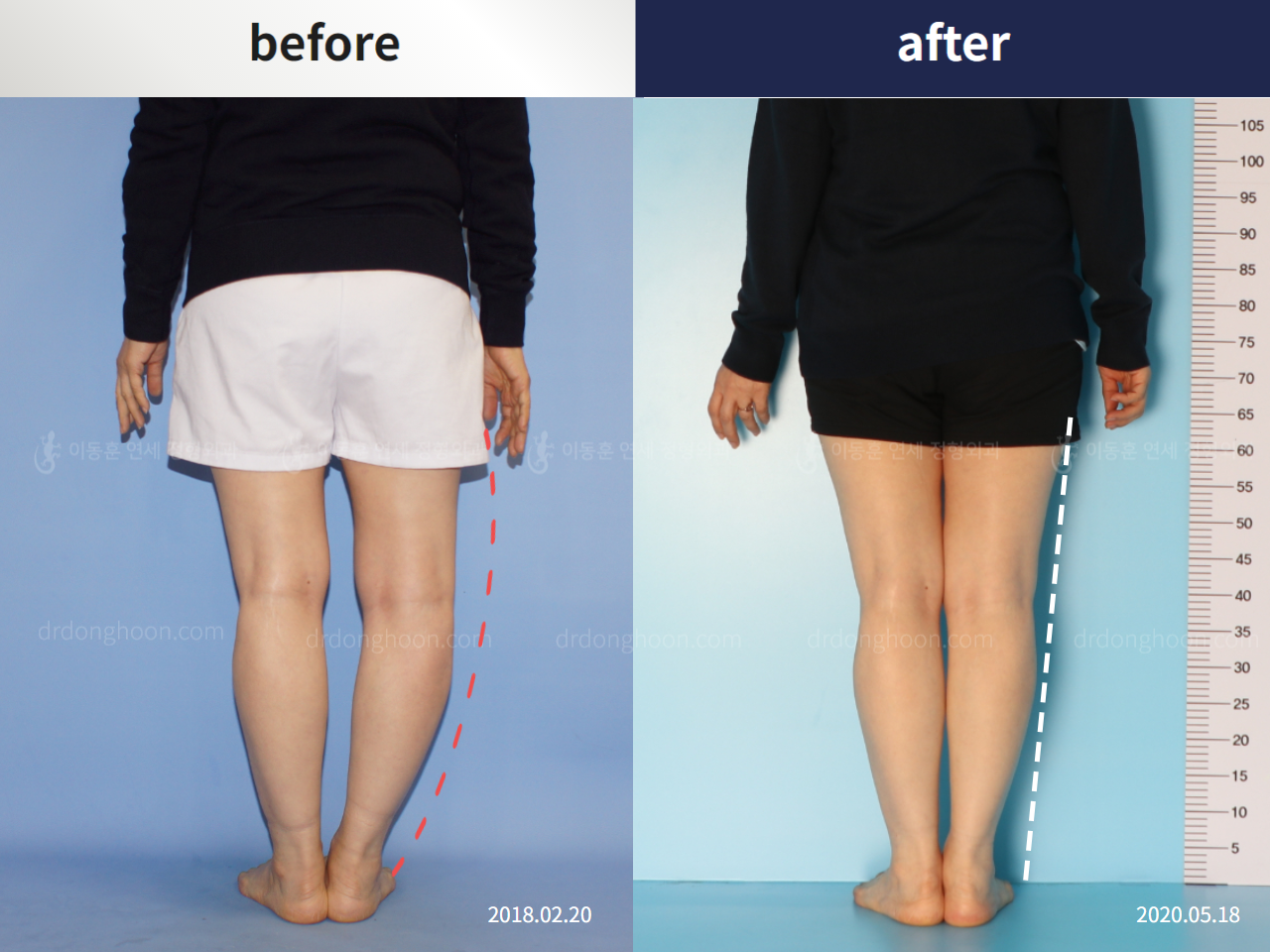 Before and after osteotomy for knee osteoarthritis, case 5409745, image 3, Dr. Donghoon institute (DALRI)