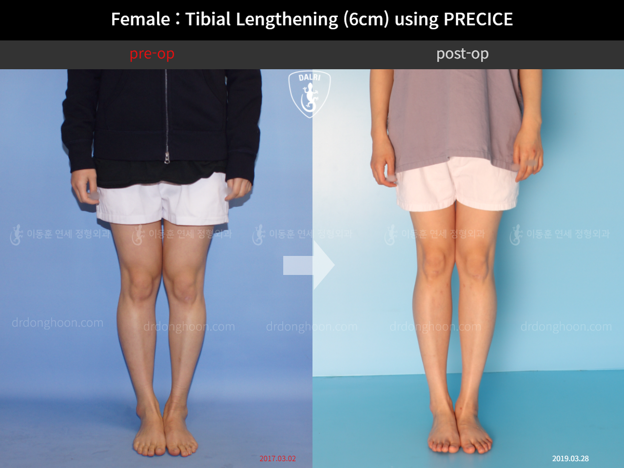 Before and after cll precice, case 11653827, image 5, Dr. Donghoon institute (DALRI)