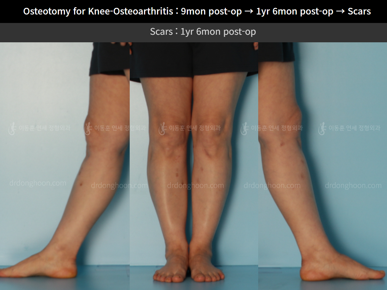 Before and after osteotomy for knee osteoarthritis, case 11203744, image 6, Dr. Donghoon institute (DALRI)